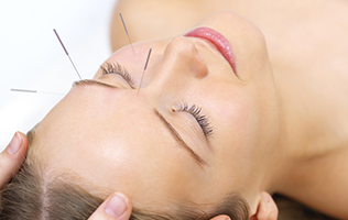 Maux de tête: l’acupuncture à la rescousse?