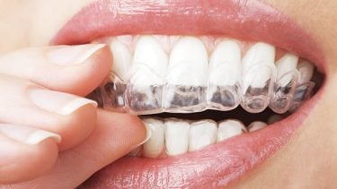 Blanchiment des dents : tout ce qu'il faut savoir